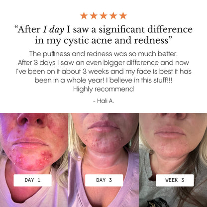 The Complete System for Acne-Prone Skin