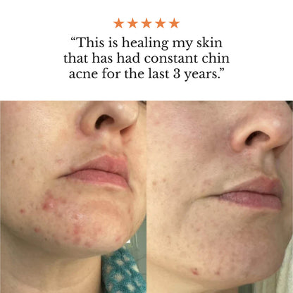 The Complete System for Acne-Prone Skin