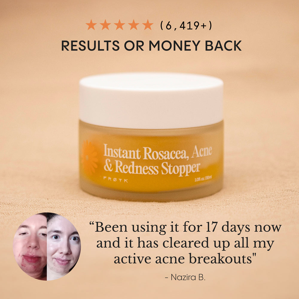 The Complete System for Acne-Prone Skin